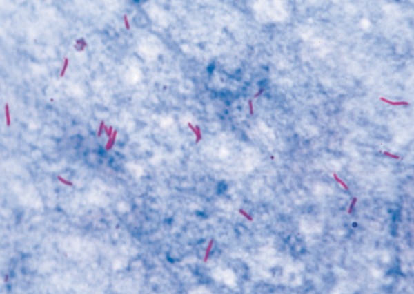 Mycobacterium tuberculosis