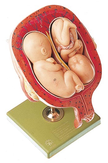 Uterus mit Zwillingsfeten im