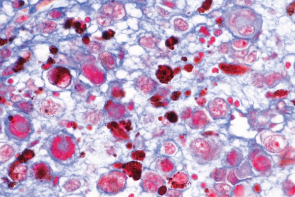 Krebs-Metastasen (Karzinom),